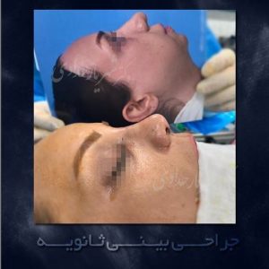 بهترین جراح ترمیم بینی | بهترین جراح بینی ترمیمی + عکسهای ترمیم بینی | بهترین دکتر ترمیم بینی در تهران