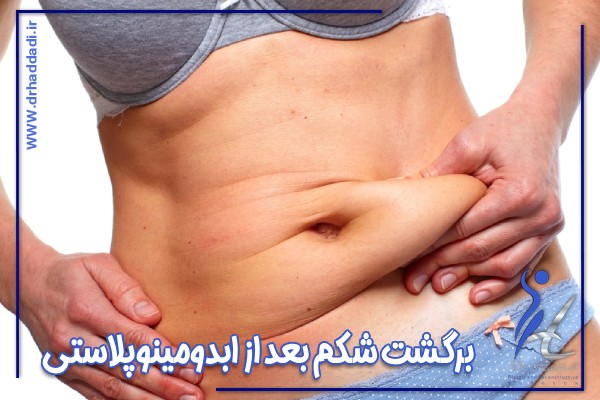 برگشت شکم بعد از ابدومینوپلاستی