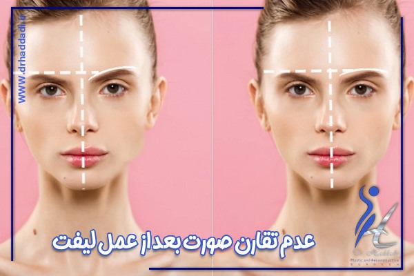 عدم تقارن بعد از لیفت صورت